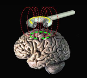 transcranial magnetic stimulation to treat depression in syracuse new york